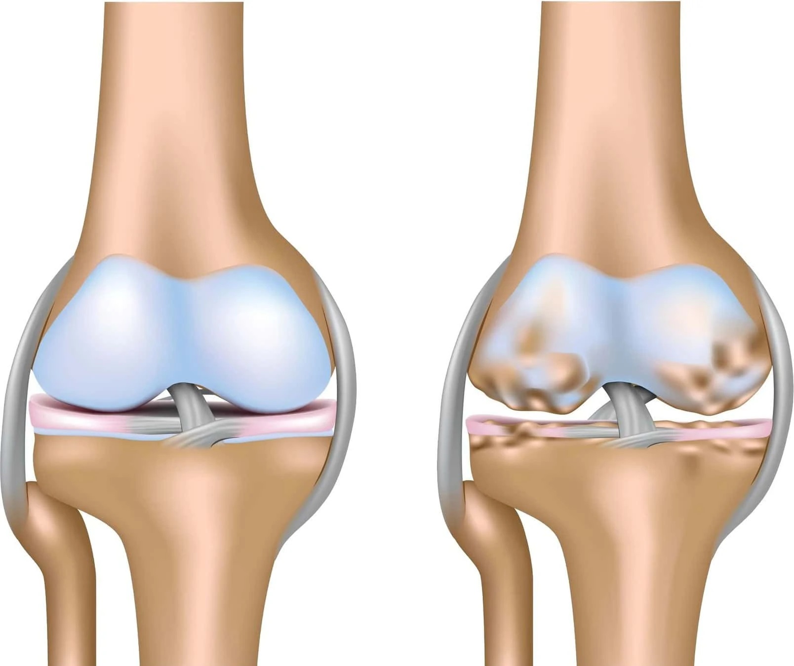 Gonartroza - osteoartrita genunchiului